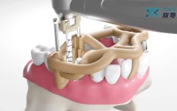 数字化种牙导版，如何通过数字化指导精准种牙？