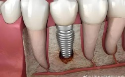 上海种植牙即刻种植效果如何？适合哪些人？价格贵不贵呢？