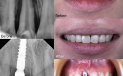 上颌没牙种8颗是常规方案吗？这样种植效果有保障吗？