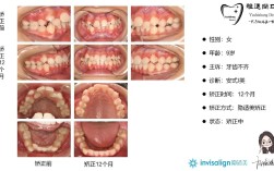 隐适美正畸57付，矫正效果能达标吗？