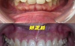 隐形矫正牙齿有后遗症