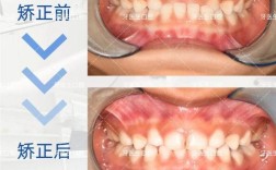 错颌畸形矫正方法有哪几种？不同情况如何选？