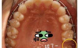 正畸牙齿要拔智齿吗