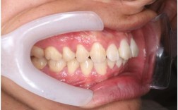 正畸下牙移动的更快