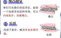 嘴突正畸是否都需要骨钉？正畸医生详解适用条件