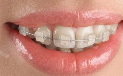 陶瓷半隐形矫正牙齿，半隐形效果如何？