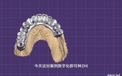 数字化种牙技术如何实现精准高效种植？