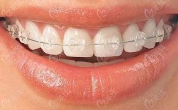 正畸陶瓷自锁矫正相比传统矫正有哪些优势？