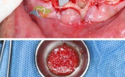 牙周植骨半年后