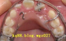 磨牙扭转90度，正畸矫正能恢复正常吗？