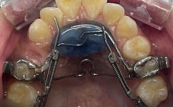 磨牙推进器如何正确安装？步骤与要点是什么？