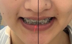 正畸中线偏移为何发生？如何有效矫正与预防？