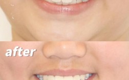 矫正牙齿后皮肤松弛，是矫正导致的吗？