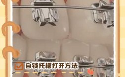 牙齿矫正自锁和活动翼