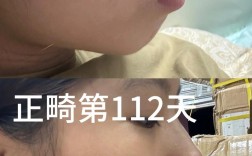 矫正牙齿后嘴变凸，是矫正方式问题还是必然结果？