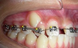 正畸过程中加弹簧