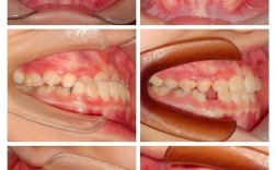 反颌偏颌，掩饰性正畸矫正效果如何？