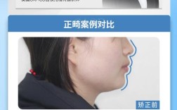 颏唇沟过深正畸有用吗