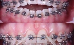 正畸矫正时铁丝两边跑是什么原因？需要怎么处理？