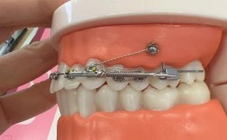 正畸内收多了，能通过拉回矫正吗？