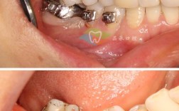 拜博口腔超声刀拔牙优势有哪些？