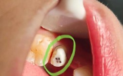 种的牙桩上发现小孔，这是怎么回事？需要担心吗？