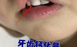 牙齿矫正后钙化