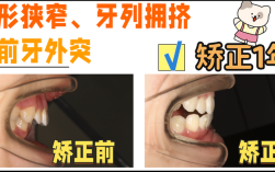 牙齿外突矫正，矫正后牙齿和脸型能改善多少？