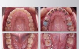 四川成都做舌侧正畸效果好不好？