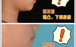 唇倾下前牙的方法有哪些？如何有效实施？