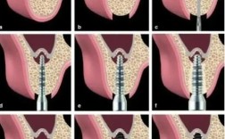 种植牙植骨的骨头从哪来？安全可靠吗？