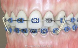 正畸弹簧上橡皮筋的正确使用方法和注意事项是什么？