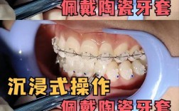 牙齿矫正陶瓷牙套