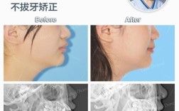 rw目标引导性正畸