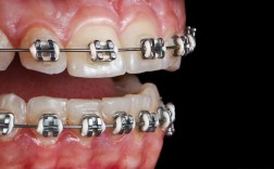 正畸 钢丝 移位