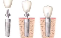 韩国种牙植体图片能帮你选对合适的植体吗？