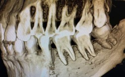 二次正畸牙根吸收