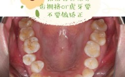 虎牙缺失影响美观？口腔正畸如何矫正？
