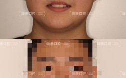 牙齿矫正自信了