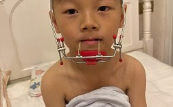 宝宝反颌（地包天）怎么纠正？有哪些安全有效的干预方法？最佳治疗时机是什么时候？