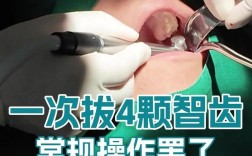 正畸前拔四颗智齿