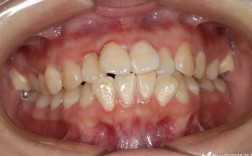 正畸高低角的拔牙