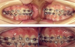 正畸前牙开合牵引如何有效进行？