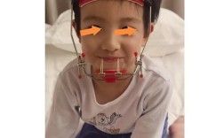 隐形儿童矫正器效果如何？孩子戴得舒服吗？安全有保障吗？