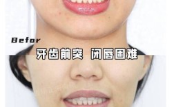 嘴前突 矫正牙齿案例