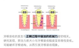 牙齿矫正会不会导致牙根吸收？