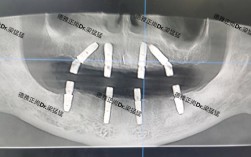 种牙自体骨吸收
