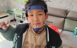 正畸颌间343牵引，343代表什么？牵引机制与效果如何？