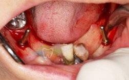 Bicon种植牙术后可能出现哪些并发症？