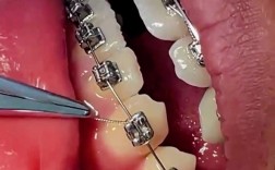 牙齿矫正后钢丝残留怎么办？不取会有影响吗？